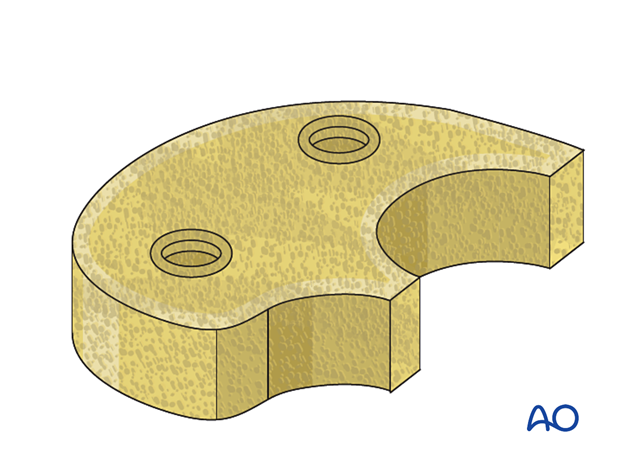 P425 Complete revision of tibial components with CCK