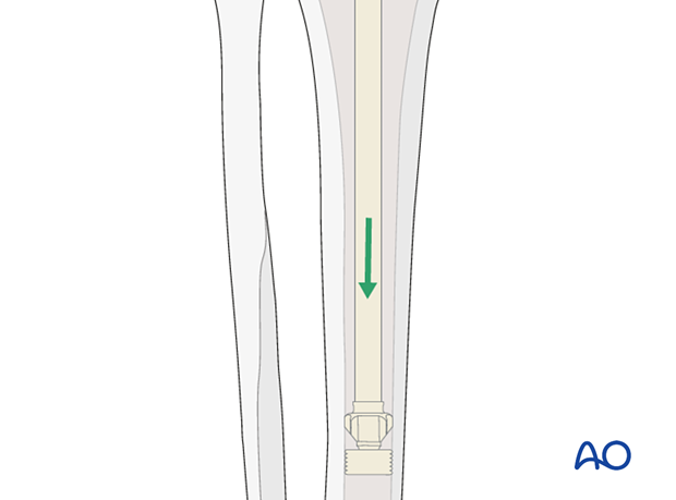 P425 Complete revision of tibial components with CCK