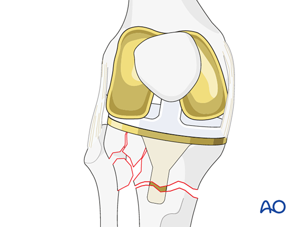 Preoperative planning