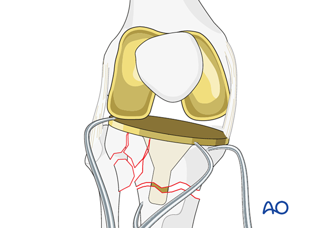 Tibial fracture provisional fixation