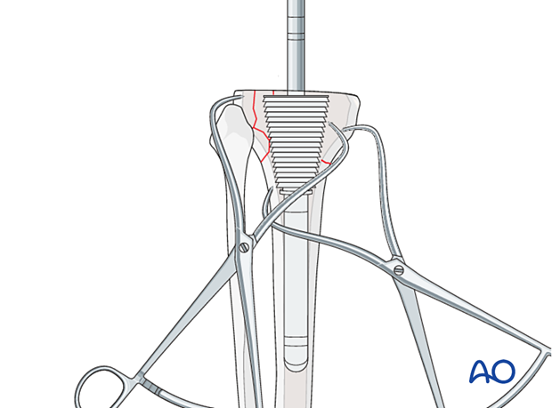 P440 Complete revision of tibial components hinged knee