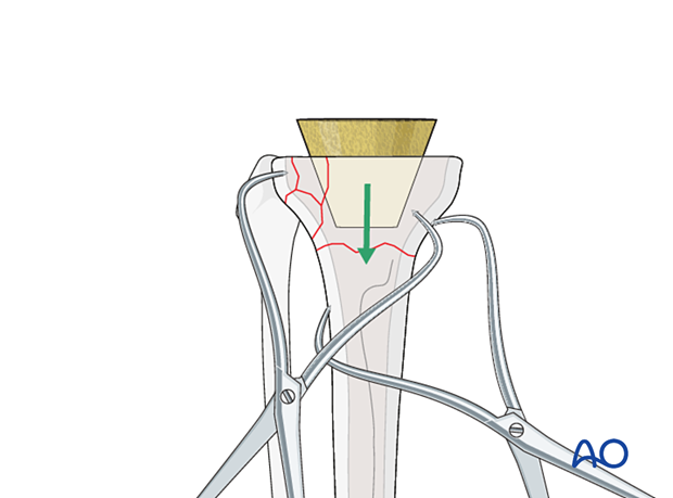 Supplemental metaphyseal fixation