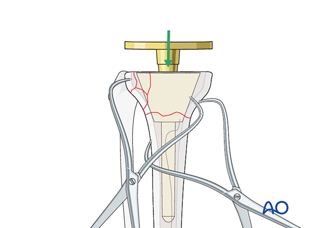 Insertion of tibial component