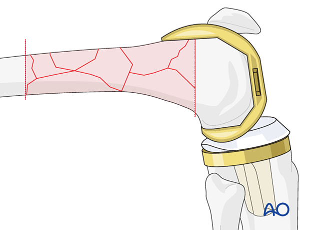 Additional bone resection may be necessary according to preoperative planning