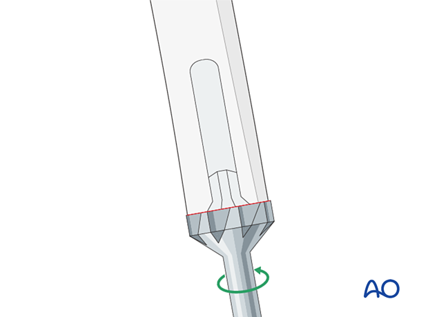 Preparation of the femur