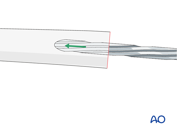 The femoral canal is prepared with reamers of increasing size