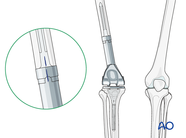 P445 Distal femoral replacement