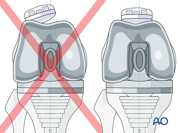 P445 Distal femoral replacement