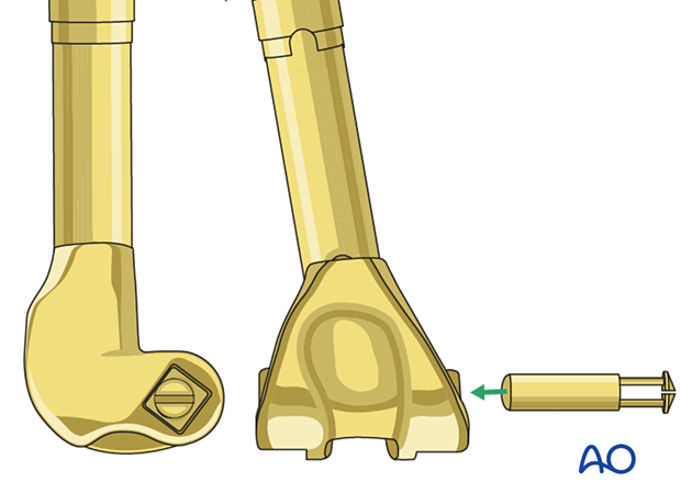 P445 Distal femoral replacement