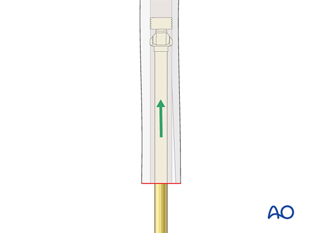 Cement restrictor