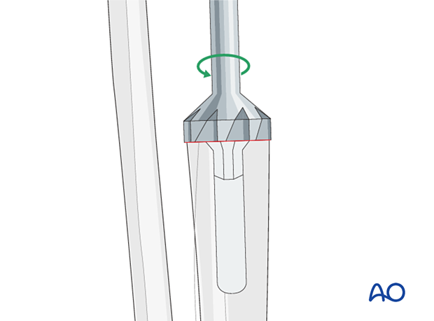 tibia resection level