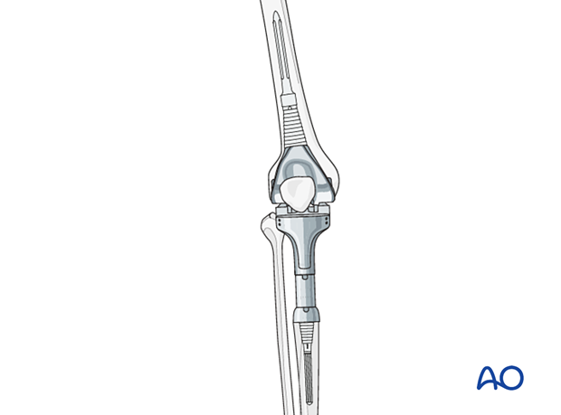 Rotational alignment