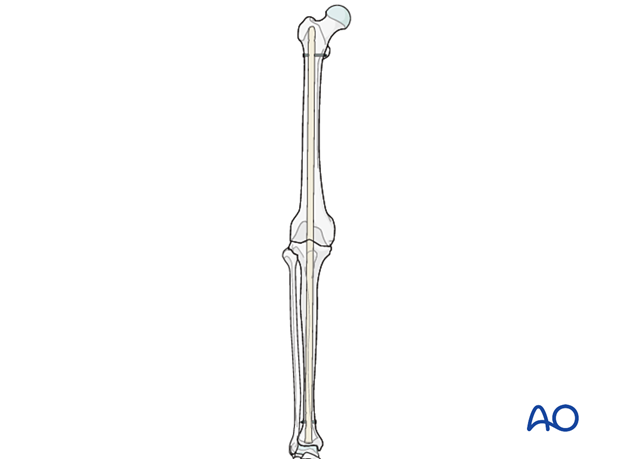 intramedullary nail stabilization for knee arthrodesis